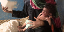 Un niño desnutrido y hambriento en Yemen Un niño desnutrido y hambriento en Yemen