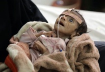 El niño Udai Faisal, que sufre malnutrición, es hospitalizado en el hospital As-Sabeen en Sana, Yemen