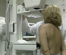 Un fármaco antiestrógeno reduce riesgo de cáncer de mama en un 65%: estudio Un fármaco antiestrógeno reduce riesgo de cáncer de mama en un 65%: estudio