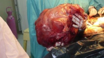 Un tumor de 23 kilos Un tumor de 23 kilos