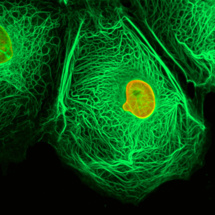 Agencia mundial advierte sobre "alarmante incremento" de casos de cáncer Agencia mundial advierte sobre "alarmante incremento" de casos de cáncer