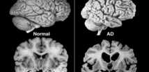 A la izquierda, un cerebro normal, y a la derecha un cerebro afectado por el Alzheimer