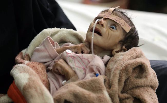 Un niño malnutrido en Yemen