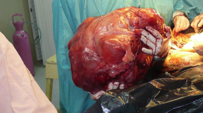 Un tumor de 23 kilos