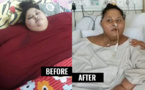 La mujer más obesa del mundo pierde 250 kg tras operación en India