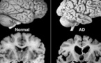 Un tratamiento experimental contra el Alzheimer da resultados alentadores
